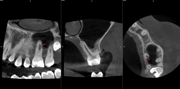 UL6 internal inflammatory resorption case image 1